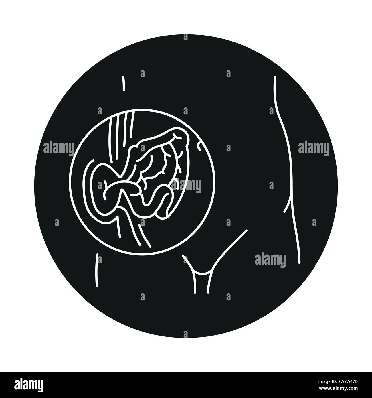 Hernia inguinal illustration hi-res stock photography and images - Alamy