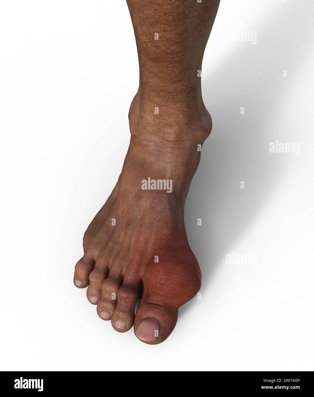 Gout foot hires stock photography and images Alamy