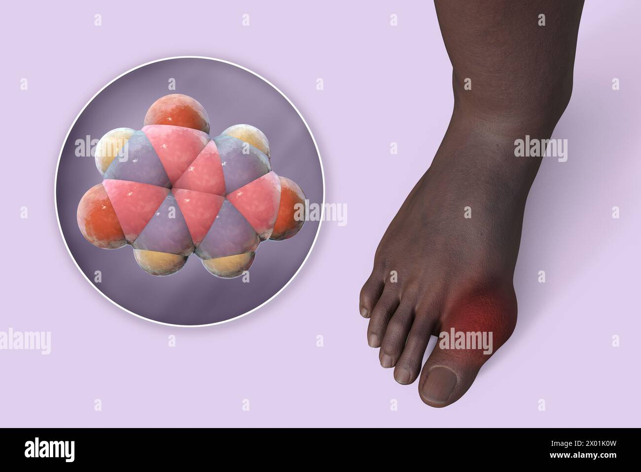 Illustration of gout-afflicted foot and close-up view of uric acid ...