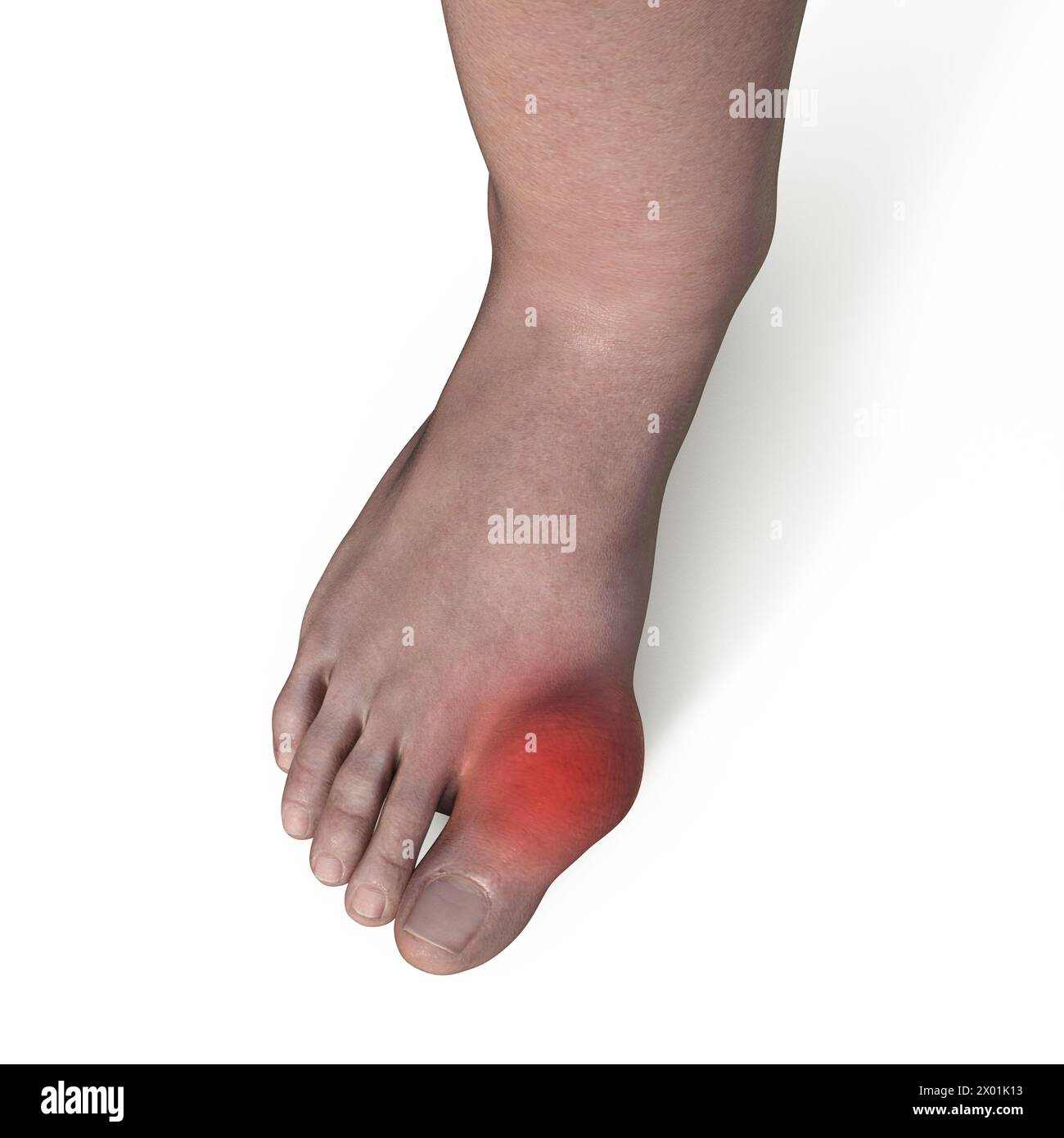 Gout Foot Deformity at Lashay Carlson blog