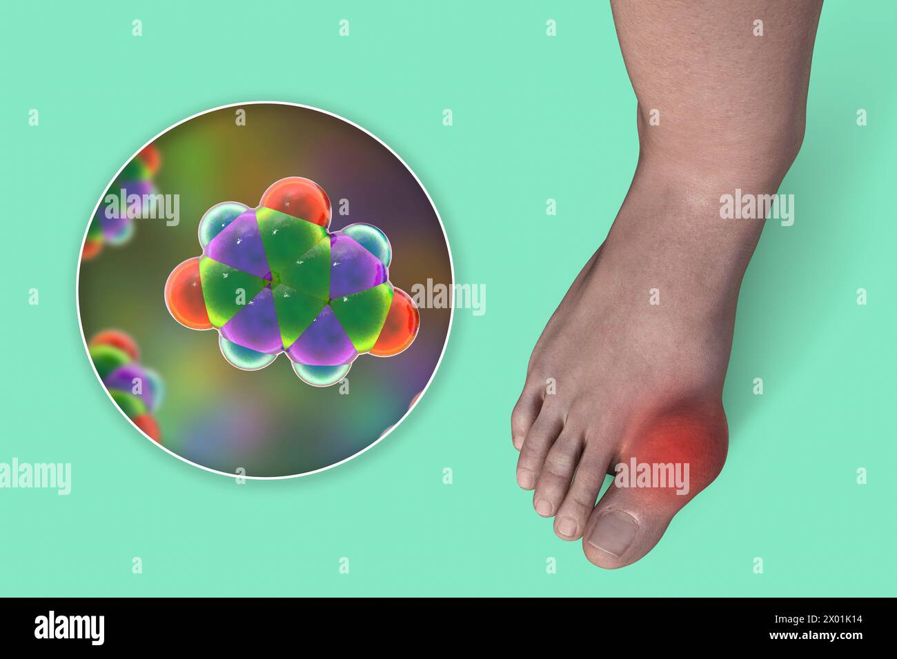 Illustration of gout-afflicted foot and close-up view of uric acid molecule, revealing the destructive impact of chronic uric acid crystal deposition. Stock Photo
