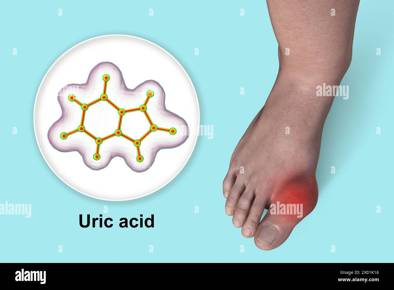 Illustration of gout-afflicted foot and close-up view of uric acid molecule, revealing the destructive impact of chronic uric acid crystal deposition. Stock Photo