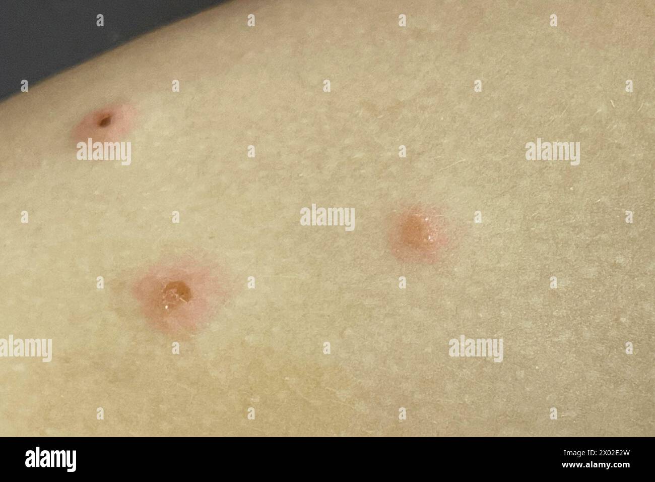 Scratched pimples on human skin. Infectious disease. Dermatology,  medicine and health care concept. Stock Photo