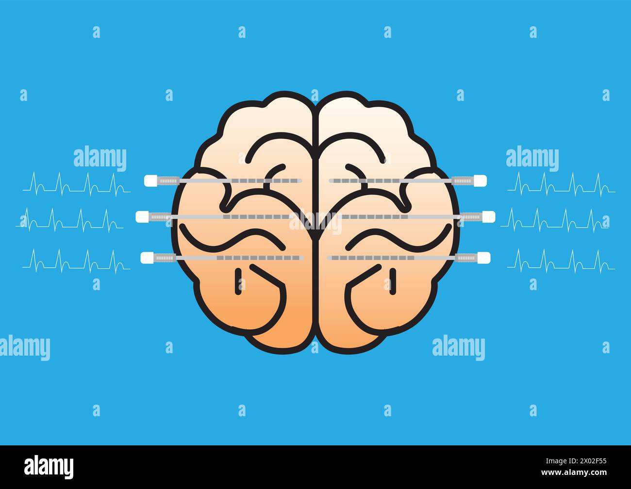 illustration of a brain with stereoelectroencephalography (SEEG) electrodes inserted into it. SEEG is a type of invasive electroencephalography used t Stock Vector