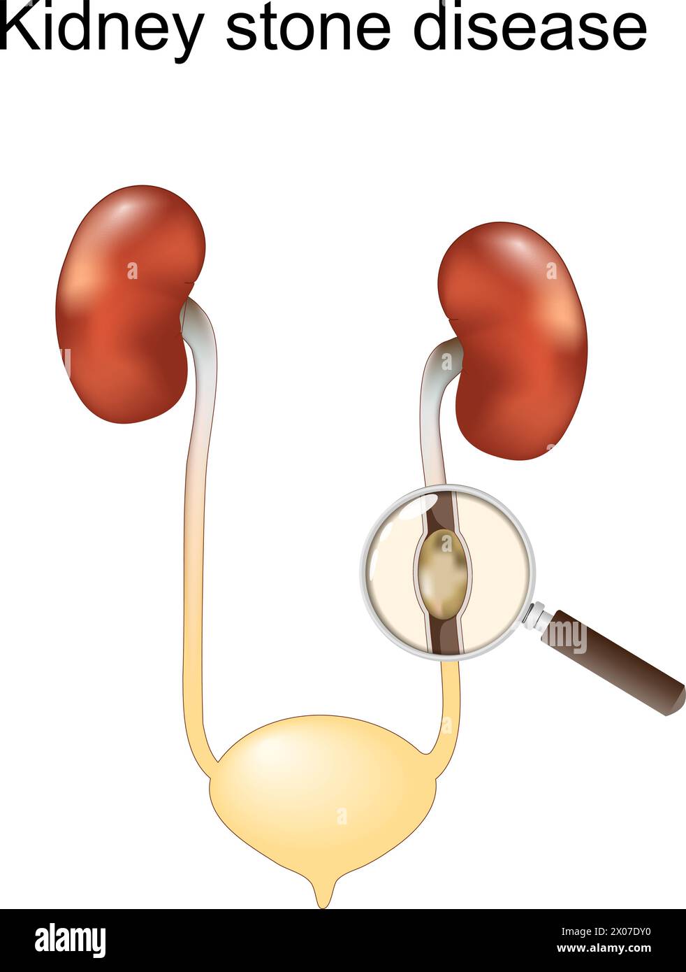 Kidney stone disease. Renal colic. Human Urinary System. Magnifying glass and Close-up of a stone into Ureter. vector illustration isolated on white b Stock Vector