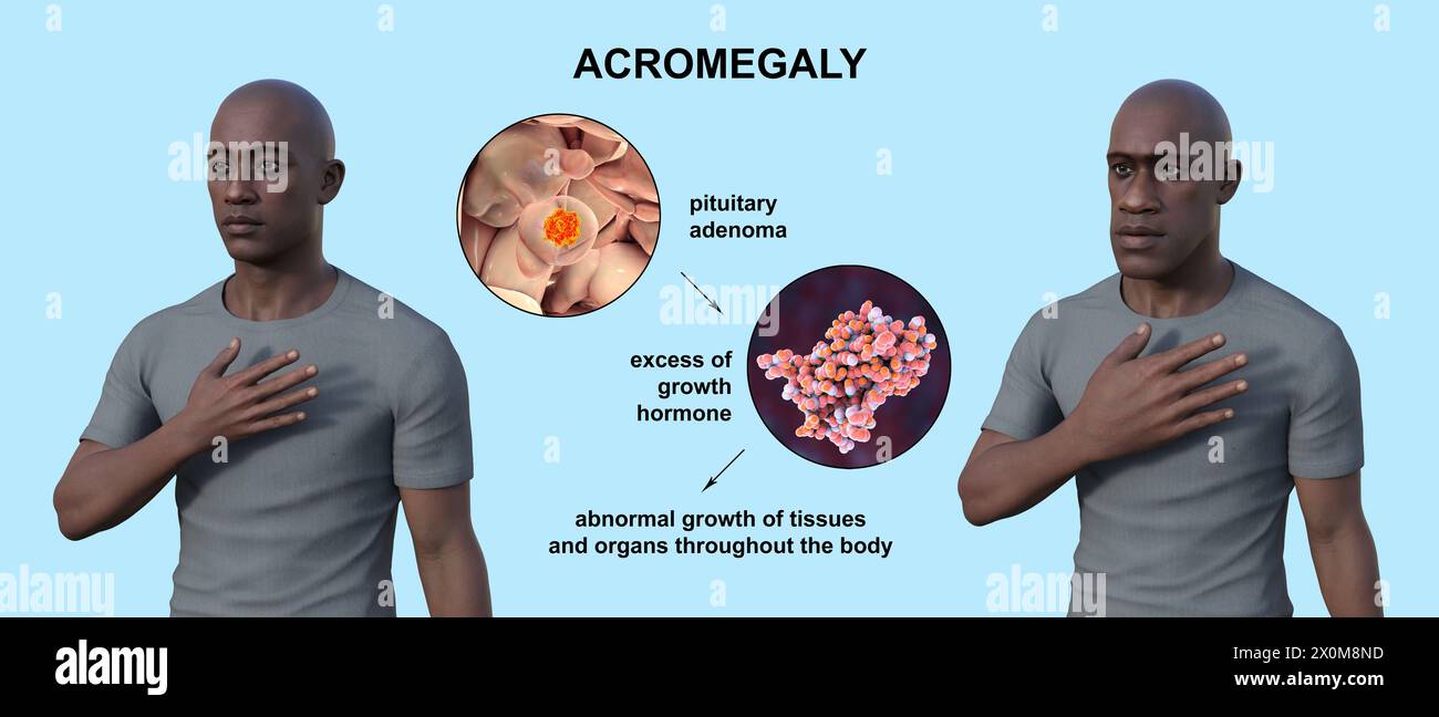 3D illustration comparing a healthy man (left) and the same man with acromegaly (right). Acromegaly is a condition causing an increase in the size of the hands and face due to the overproduction of somatotrophin (human growth hormone). It is typically a result of a benign tumour (adenoma) forming on the pituitary gland. Stock Photo