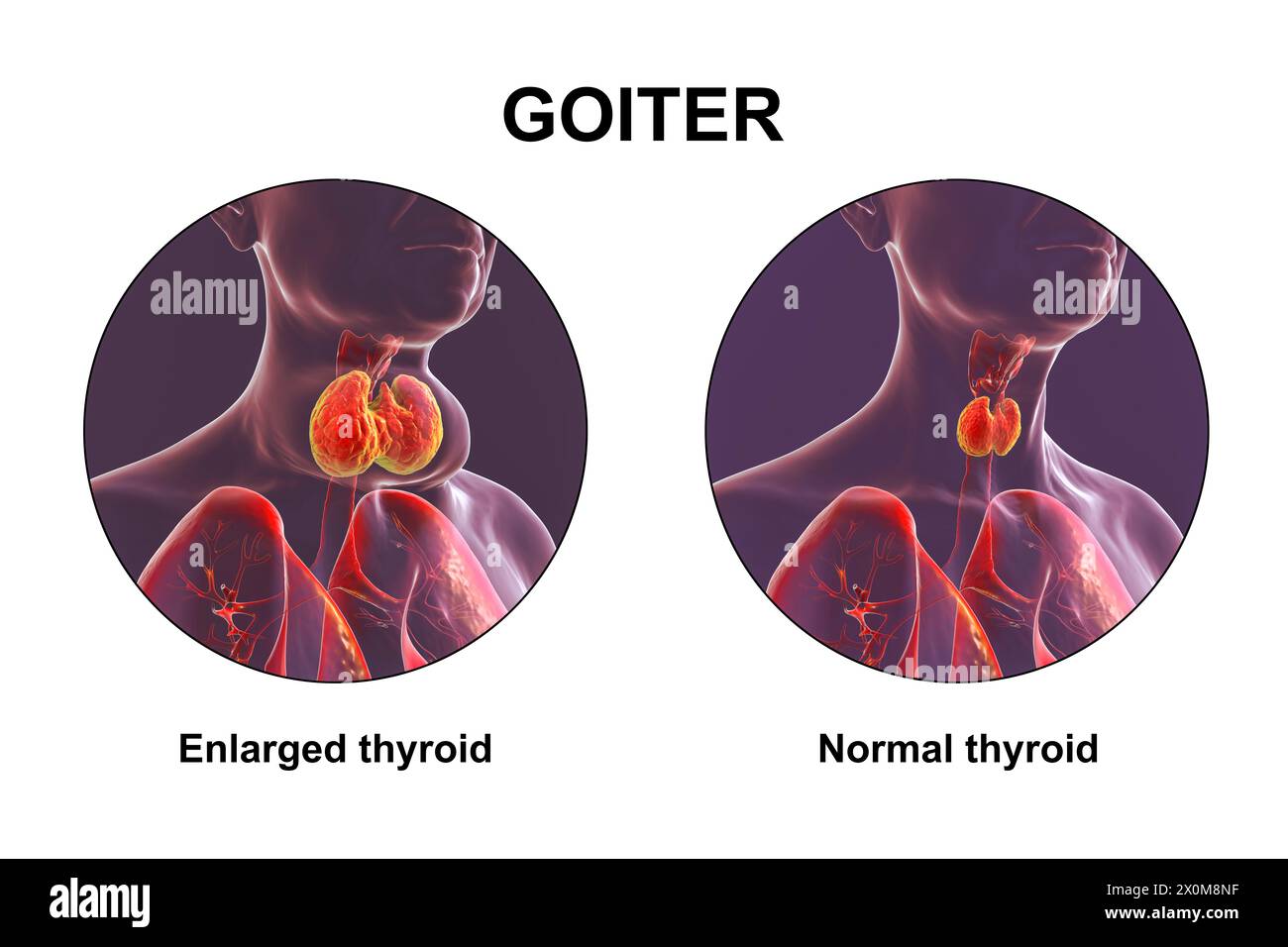 3D illustration of a person with an enlarged thyroid gland (base of neck), known as a goiter, and the same person with a healthy thyroid (right) for comparison. Stock Photo