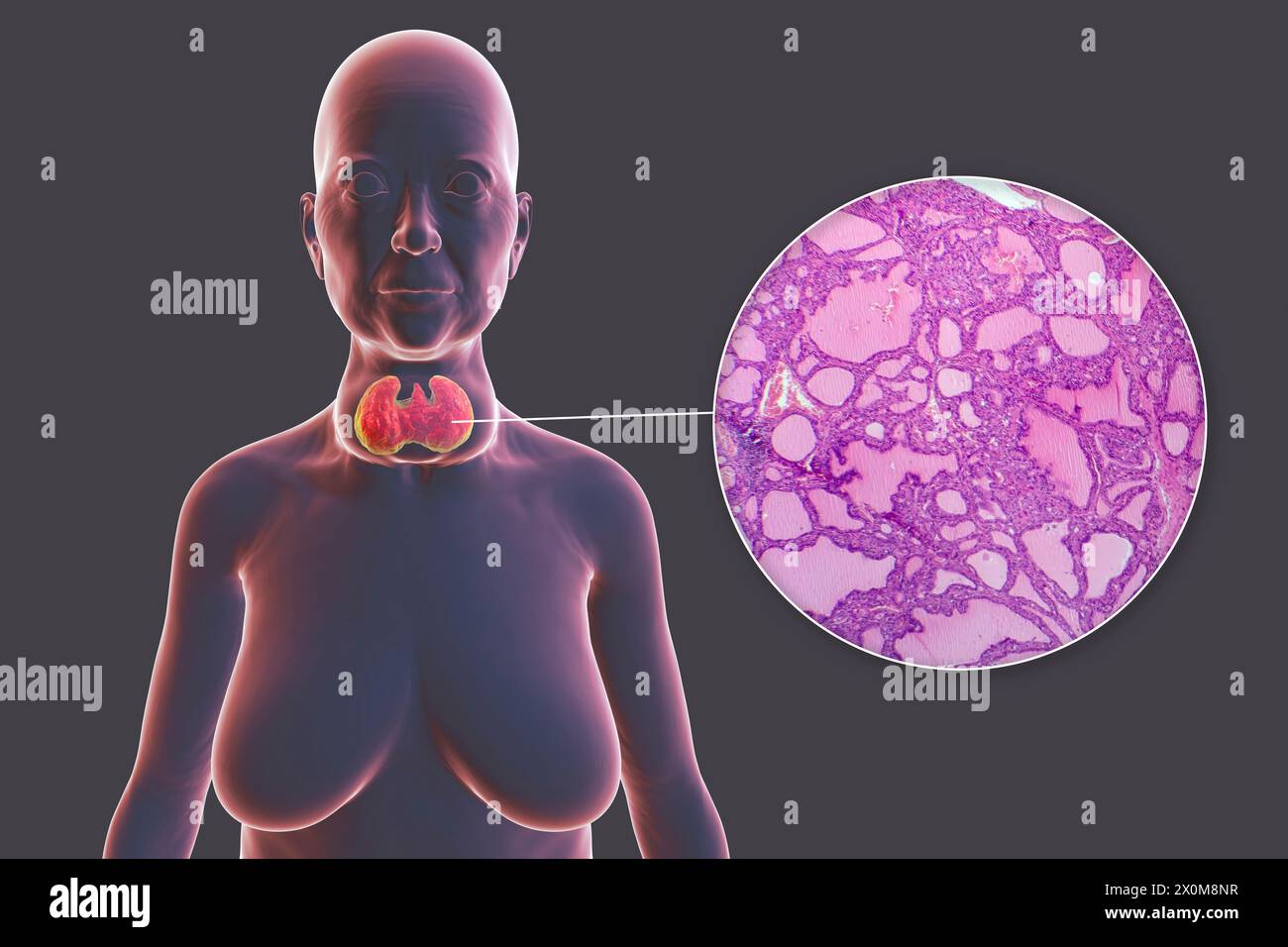 3D illustration of a person with a toxic goitre (enlarged thyroid gland, base of neck), and a close-up of the affected thyroid tissue. A goitre is deemed toxic when the enlarged thyroid gland is also producing excessive thyroid hormone. Stock Photo