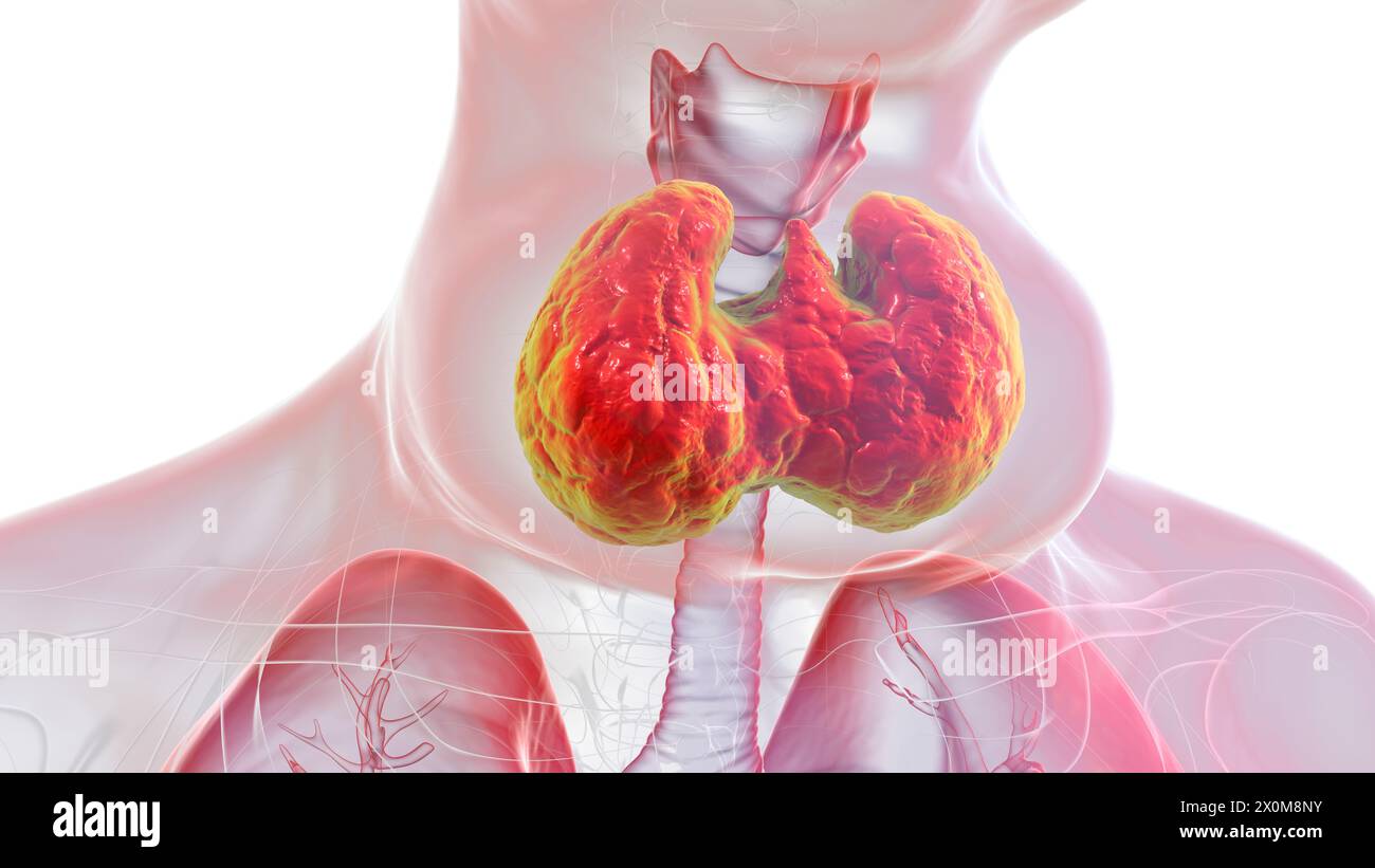 3D illustration of a woman with an enlarged thyroid gland, known as a ...