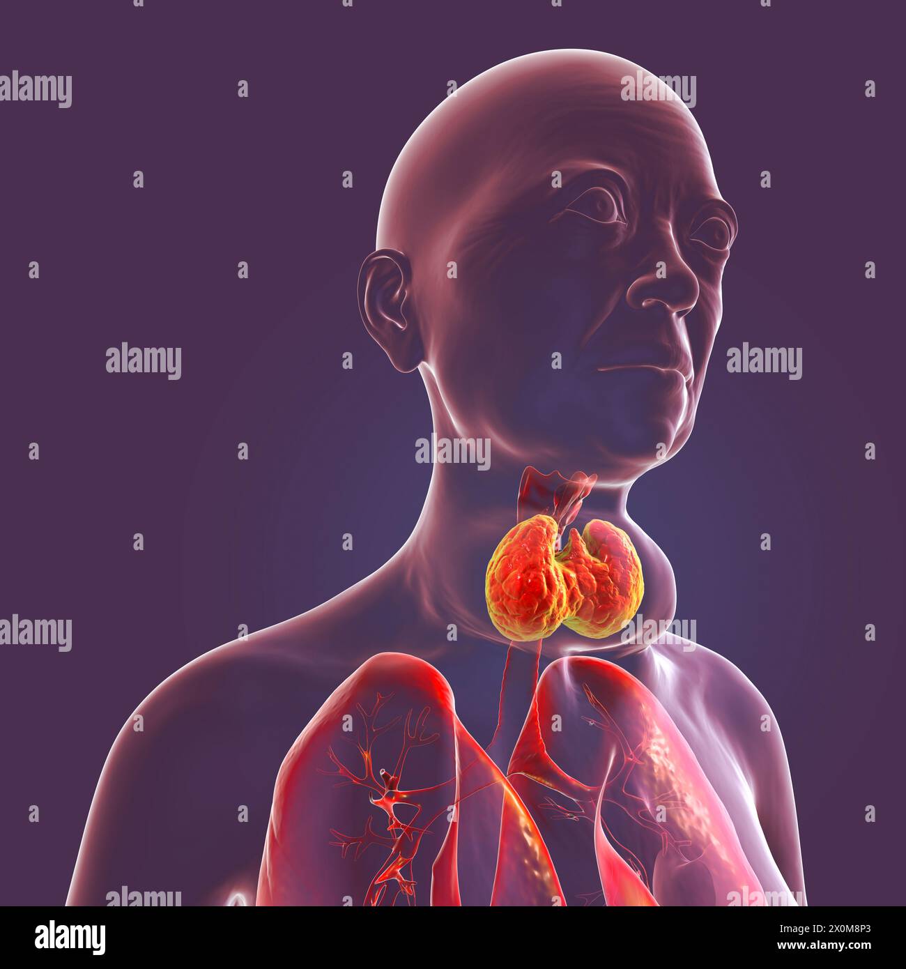 3D illustration of a woman with Graves' disease, causing an enlarged