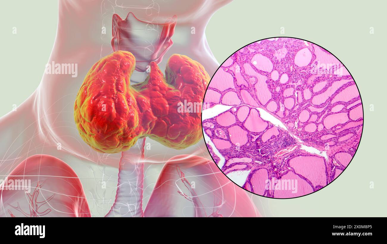 3D illustration of a person with a toxic goitre (enlarged thyroid gland, base of neck), and a