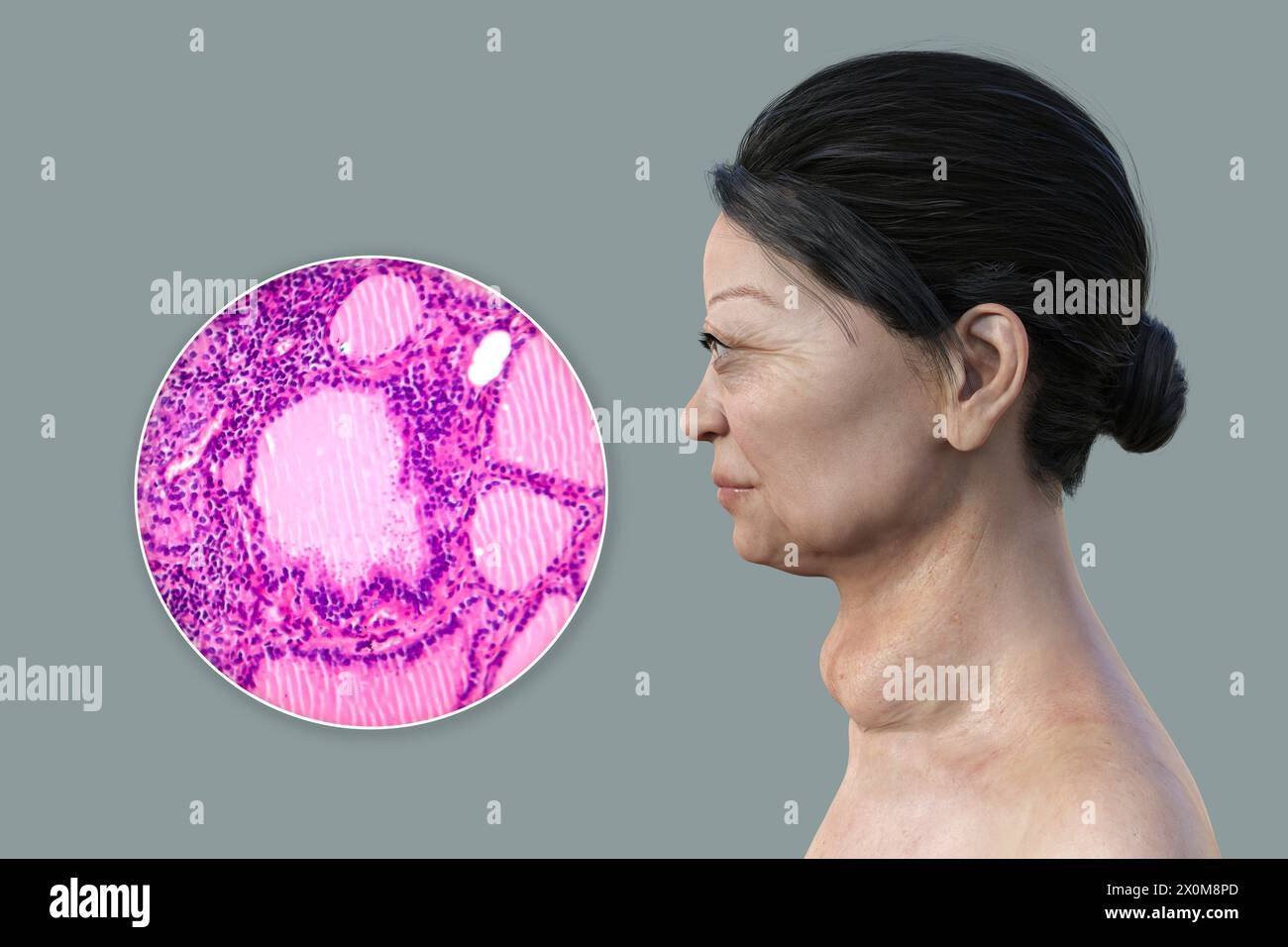 3D illustration of a woman with Graves' disease and a closeup of the