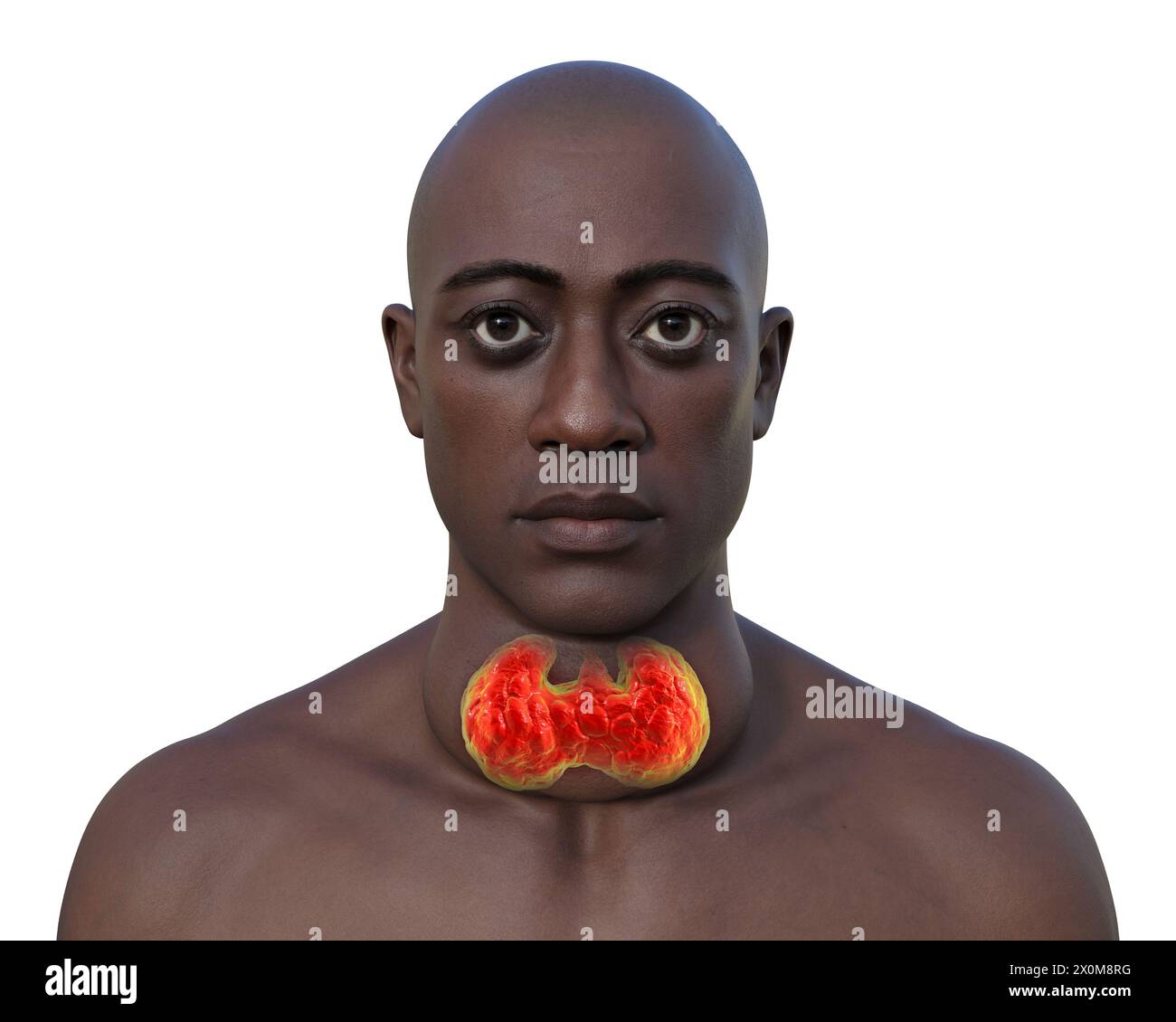 3D illustration of a man with an enlarged thyroid gland (goitre, base of neck) and abnormal protrusion of the eyes (exophthalmos). These are two sympt Stock Photo