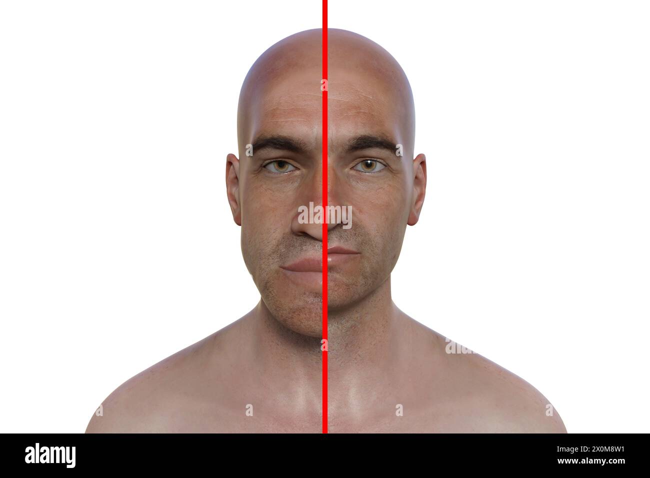 3D illustration comparing a man with acromegaly (left) and the same healthy man (right). Acromegaly is a condition causing an increase in the size of various body parts including the facial features. It is caused by the overproduction of somatotrophin (human growth hormone) typically resulting from a benign tumour (adenoma) forming on the pituitary gland. Stock Photo