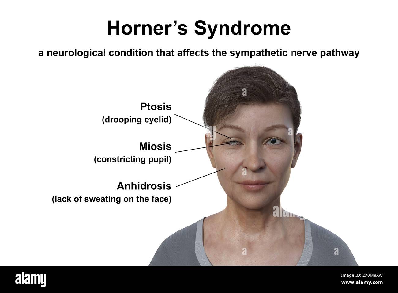 Illustration depicting a woman with Horner syndrome, depicting ptosis ...