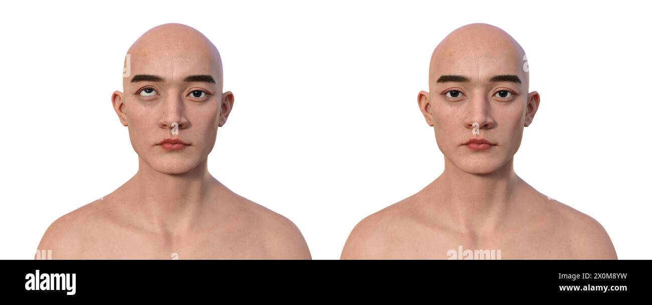 Illustration of a man with hypotropia displaying upward eye misalignment and the same healthy man. Stock Photo
