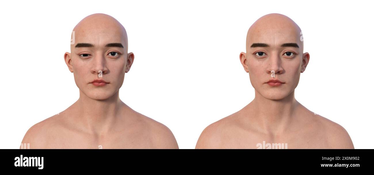 Illustration of a man with hypotropia displaying downward eye misalignment and the same healthy man. Stock Photo
