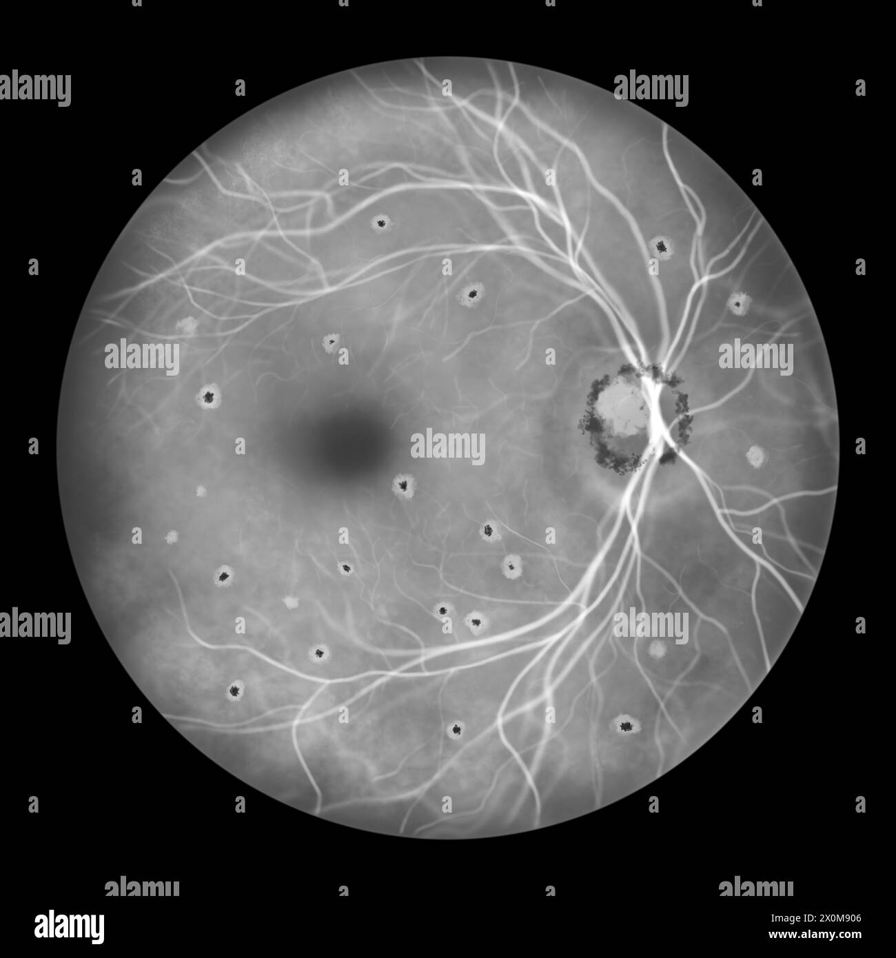 Illustration of a retina affected by presumed ocular histoplasmosis syndrome as seen in fluorescein angiography. The retina features punched-out atrophic and pigmented chorioretinal scars (histo spots) and peripapillary scarring. Stock Photo