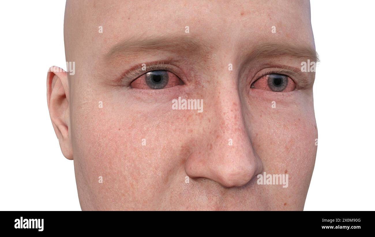 Illustration depicting a man with dry eyes, a condition marked by ...