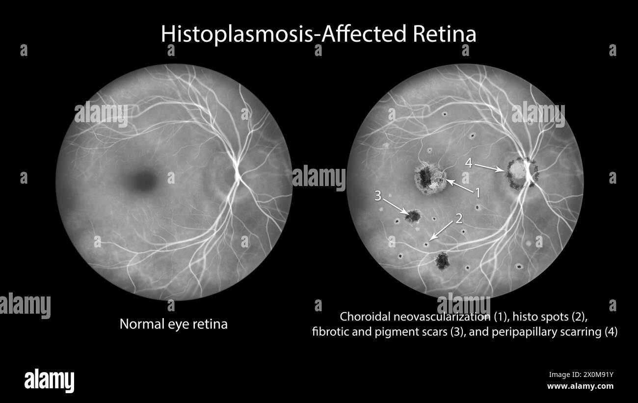 Illustration of a retina affected by presumed ocular histoplasmosis syndrome as seen in fluorescein angiography. The retina shows choroidal neovascularization, histo spots, fibrotic and pigment scars, peripapillary scarring. Stock Photo