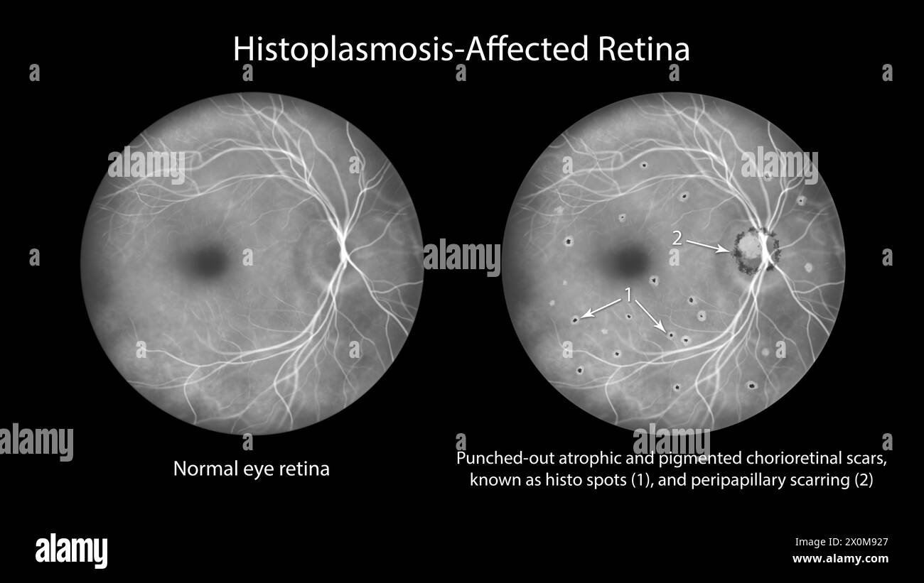 Illustration of a retina affected by presumed ocular histoplasmosis syndrome as seen in fluorescein angiography. The retina shows punched-out atrophic and pigmented chorioretinal scars (histo spots) and peripapillary scarring. Stock Photo