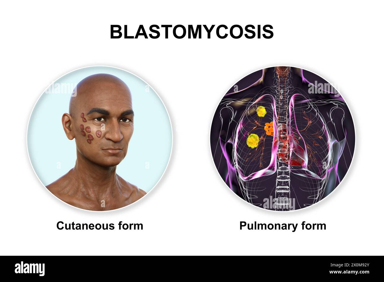 3D illustration showing two clinical presentations of blastomycosis: cutaneous (affecting the skin) and pulmonary (affecting the lungs). Blastomycosis is a fungal infection that can occur after inhaling Blastomyces dermatitidis spores. It is often asymptomatic, but where symptoms develop they primarily affect the lungs, with some patients also developing skin lesions. Stock Photo