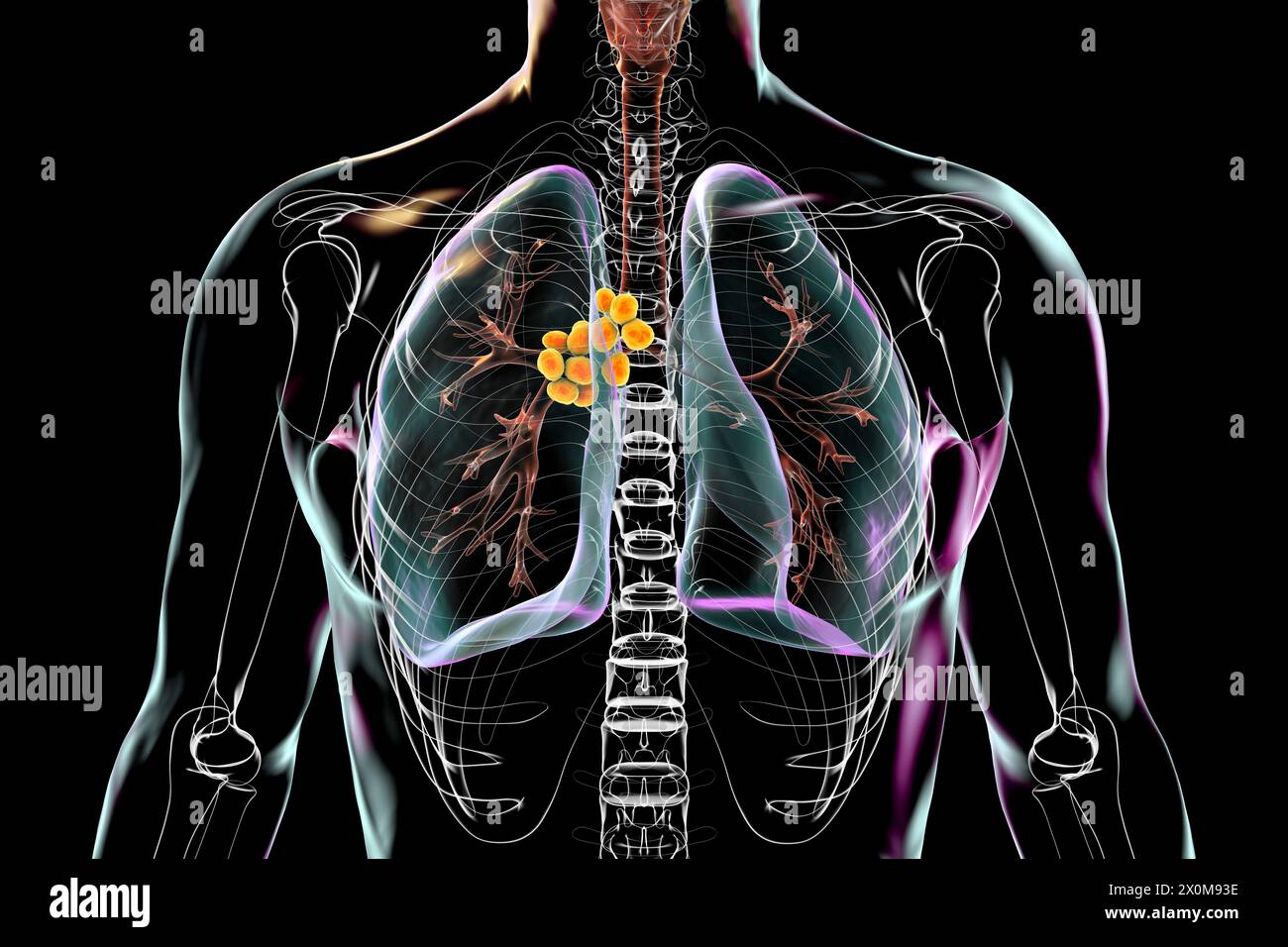 3D illustration of lungs affected by mediastinal lymphadenopathy . This is an enlargement of the lymph nodes found within the central thoracic (chest) cavity. There are multiple potential causes of mediastinal lymphadenopathy, including bacterial infection, cancer and genetic disease. Stock Photo