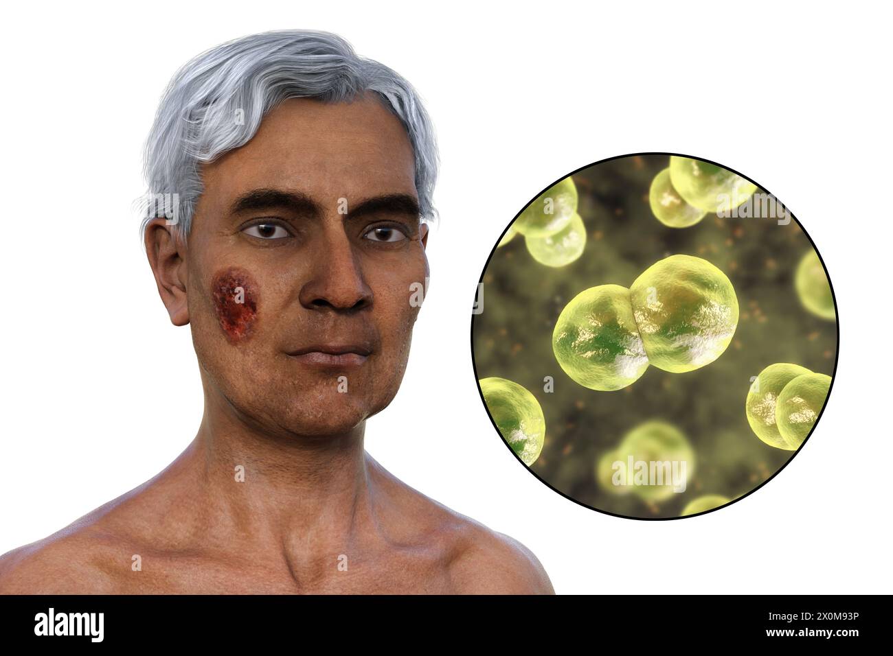 3D illustration of a man with multiple face and neck lesions caused by blastomycosis, and a close-up view of the causative Blastomyces dermatitidis fungi. Blastomycosis is often asymptomatic, but can cause lung problems. In some cases, lesions such as these develop on the skin (cutaneous blastomycosis) which can lead to irreversible scarring. Stock Photo
