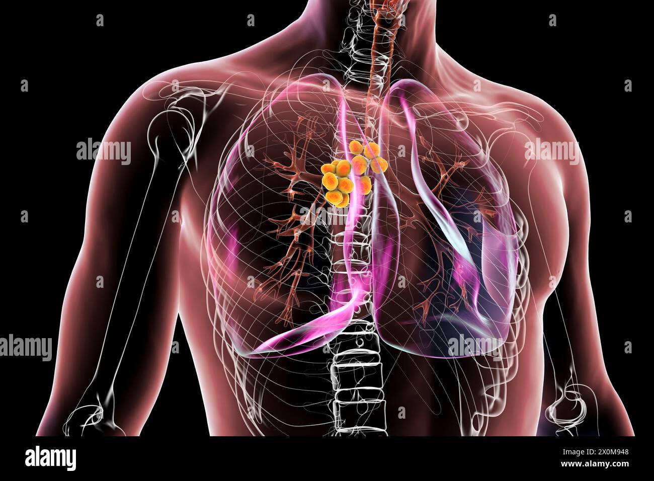 3D illustration of lungs affected by mediastinal lymphadenopathy . This is an enlargement of the lymph nodes found within the central thoracic (chest) cavity. There are multiple potential causes of mediastinal lymphadenopathy, including bacterial infection, cancer and genetic disease. Stock Photo