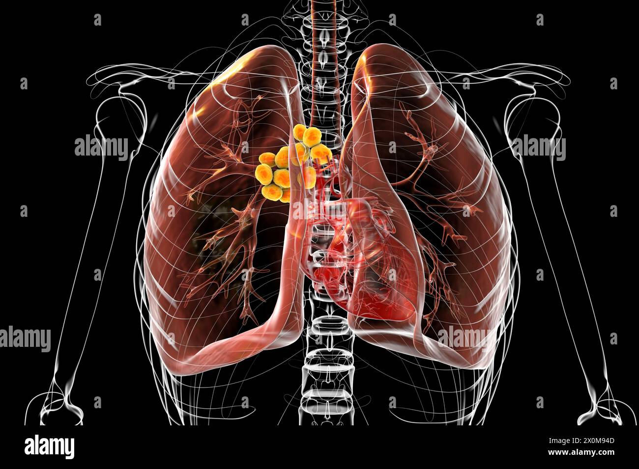 3D illustration of lungs affected by mediastinal lymphadenopathy . This is an enlargement of the lymph nodes found within the central thoracic (chest) cavity. There are multiple potential causes of mediastinal lymphadenopathy, including bacterial infection, cancer and genetic disease. Stock Photo
