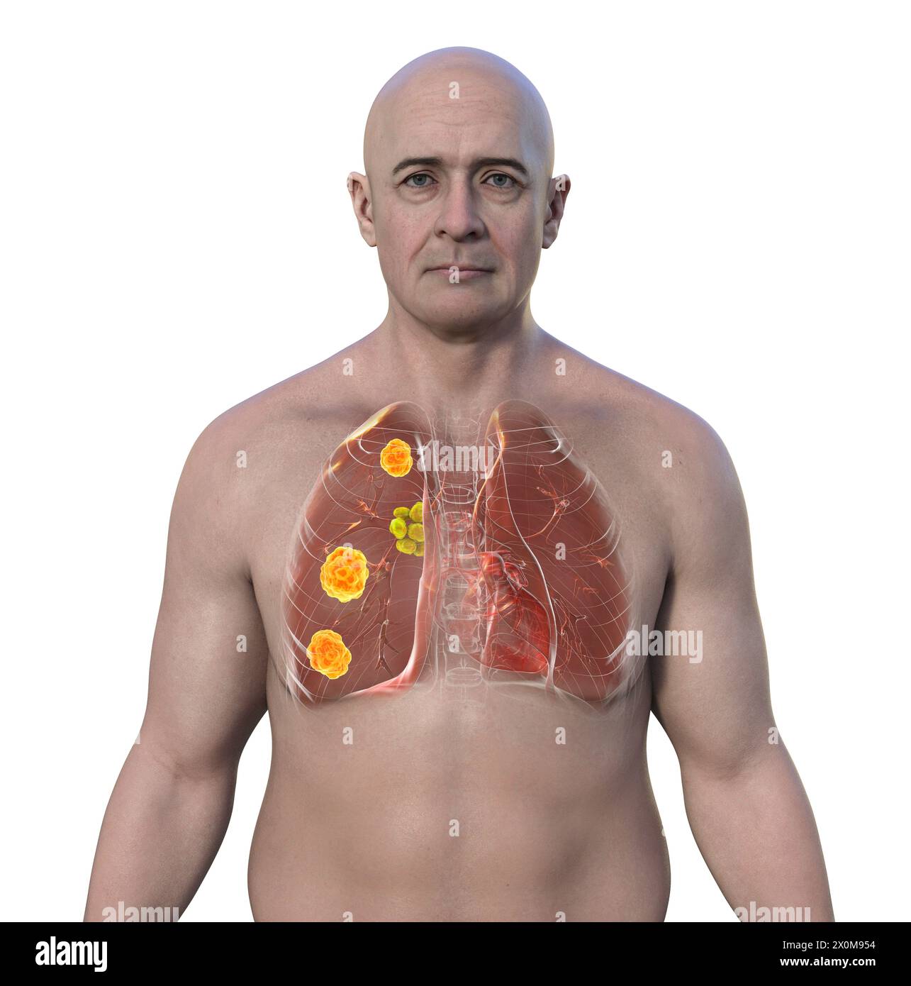 3D illustration of pulmonary blastomycosis, a fungal lung infection