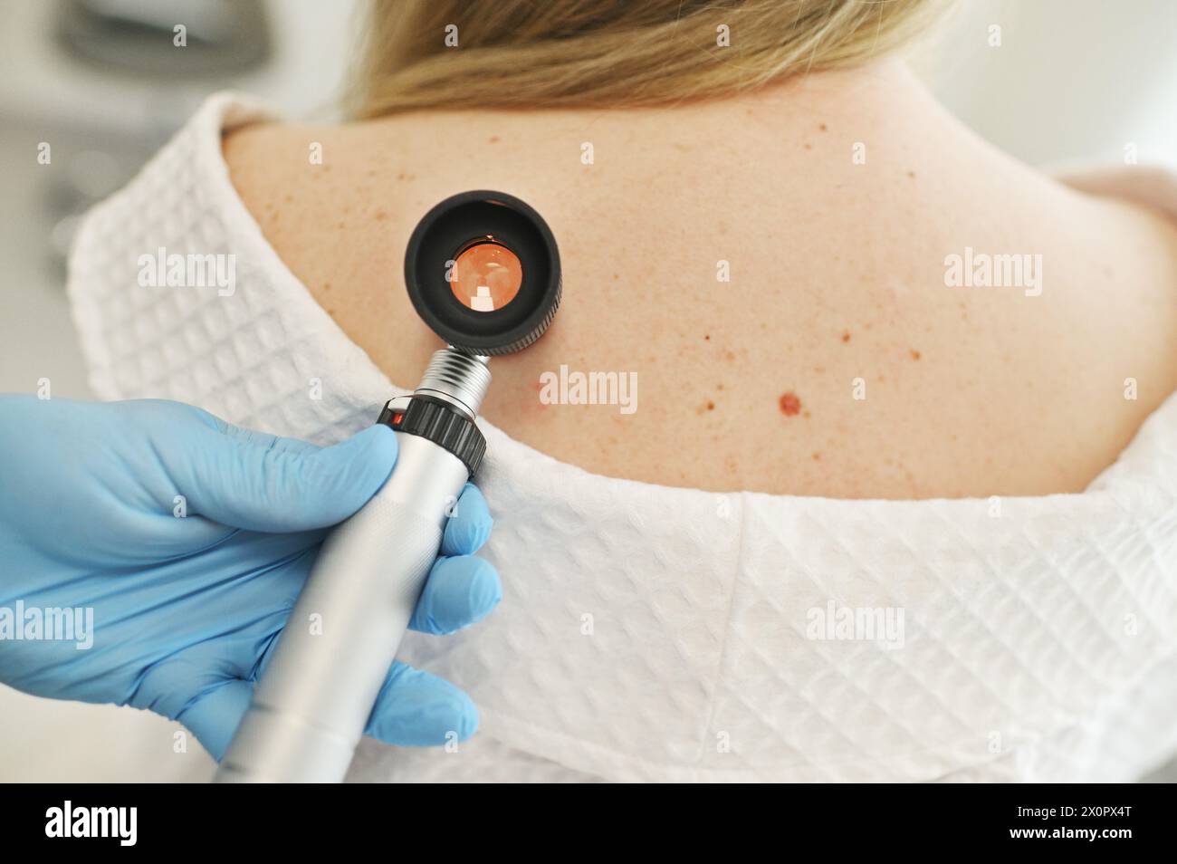 A Dermatologist Examines Moles And Skin Growths On The Patient s Body 
