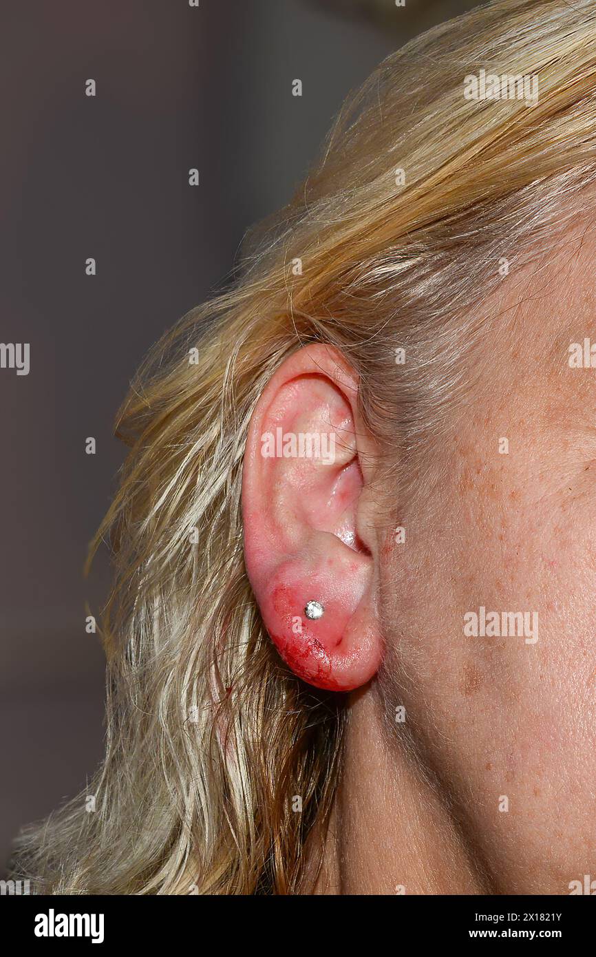 Inflamed and bloody earlobe after ear piercing Stock Photo