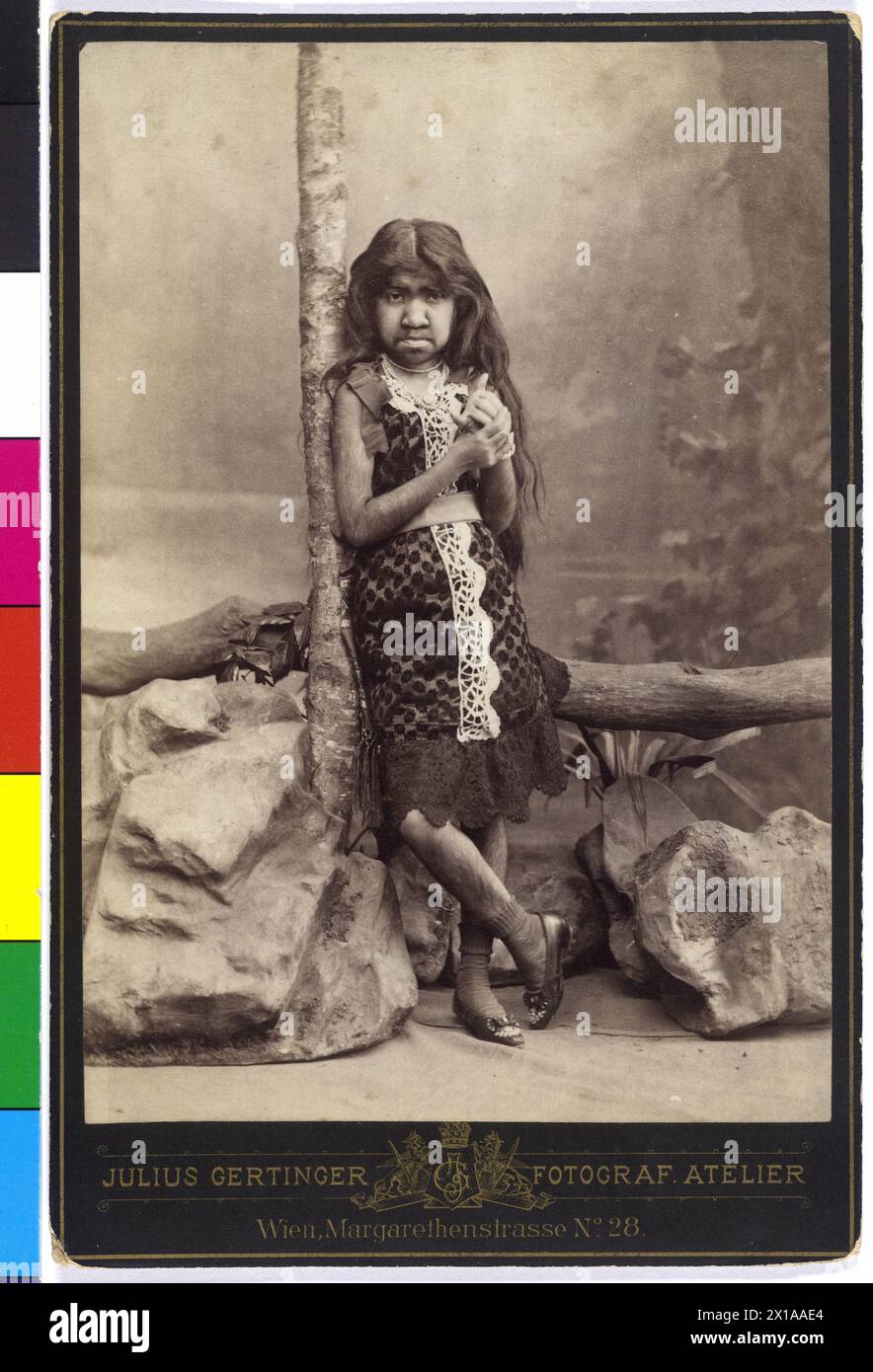 Girls with immoderate androgenic hair, 1880 - 18800101 PD0512 ...