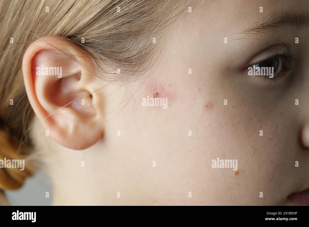 Facial skin closeup. Allergy, dermatitis, virus or bacterial infection. Dermatology,  medicine and health care concept. Stock Photo