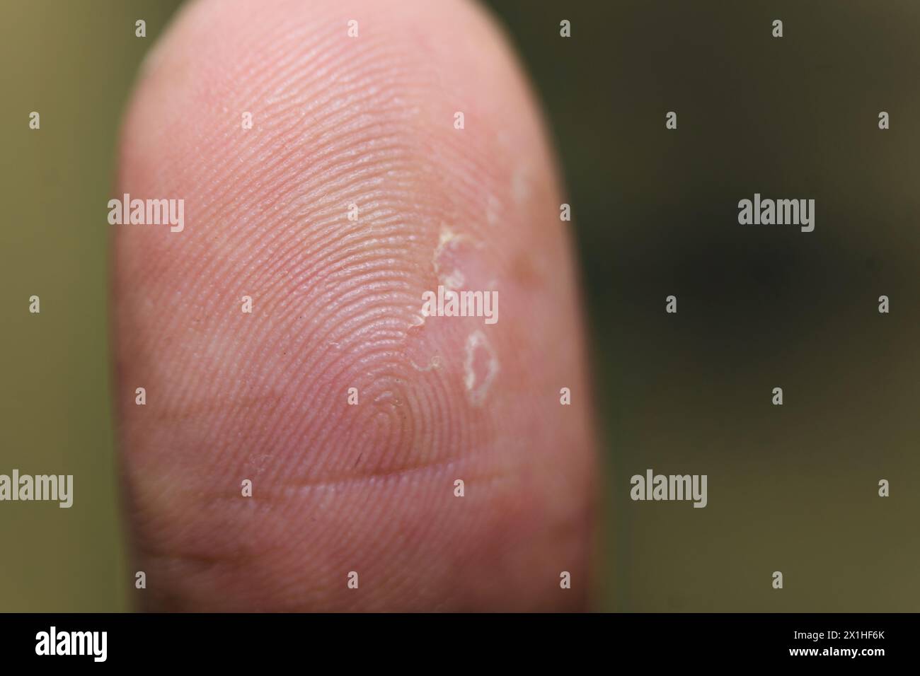 A magnified image of a fingertip showing red, inflamed, and scaly skin, possibly caused by psoriasis or eczema. Stock Photo