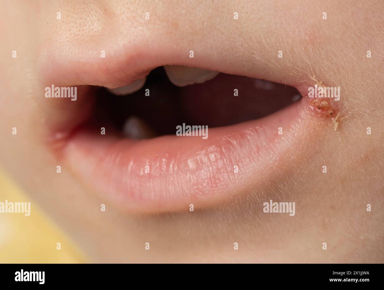 slitlike impetigo in a little girl in the corners of her mouth. Skin