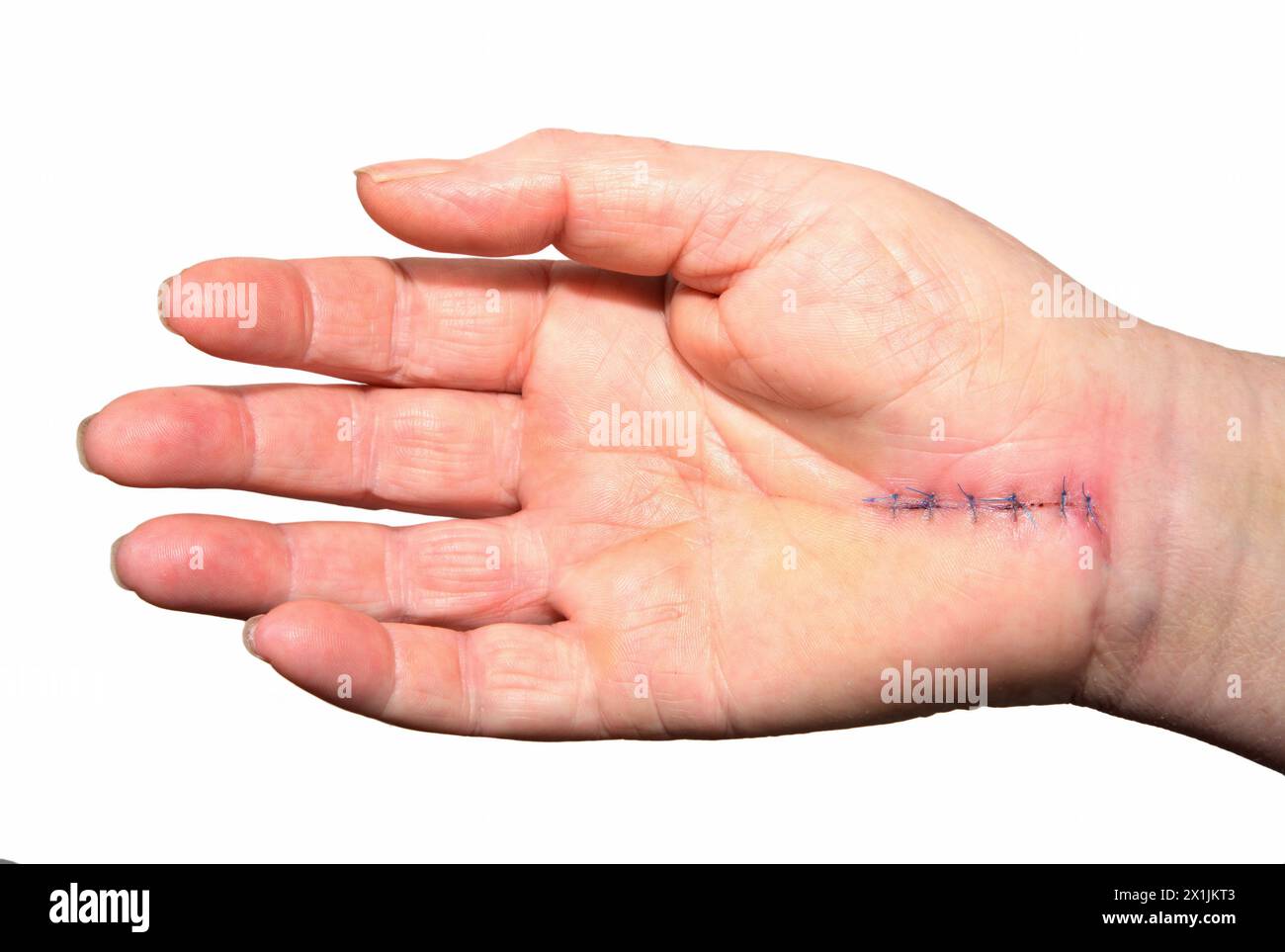Operation repaire stitches of Carpal Tunnel Syndrome relief surgery Stock Photo