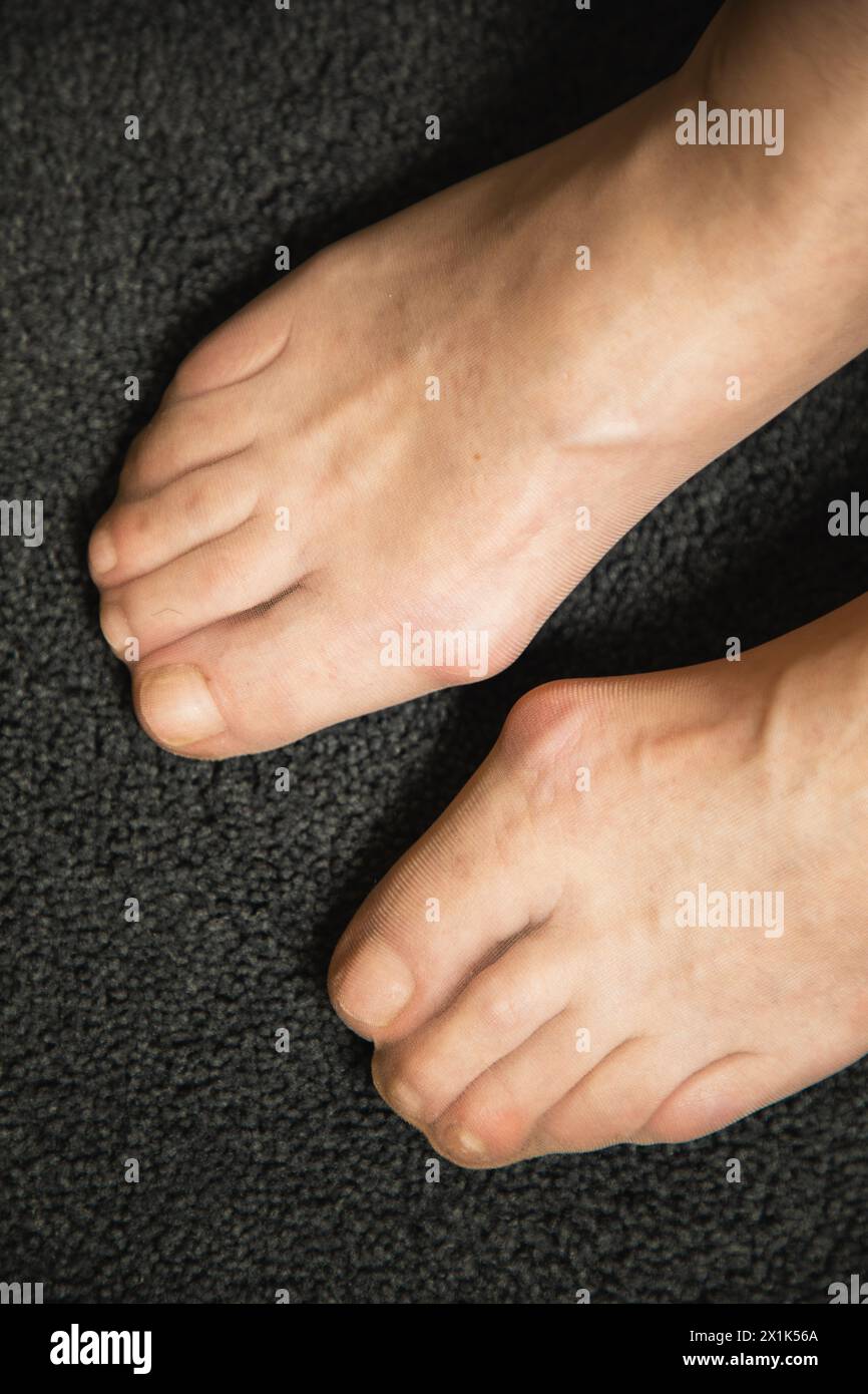 Flat feet and foot toe problems, What Problems Can Flat Feet Cause ...