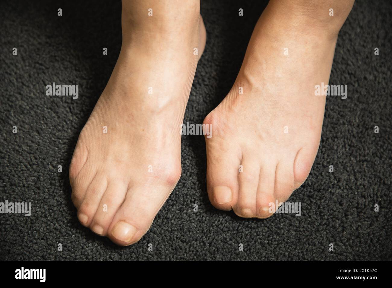 Flat feet and foot toe problems, What Problems Can Flat Feet Cause