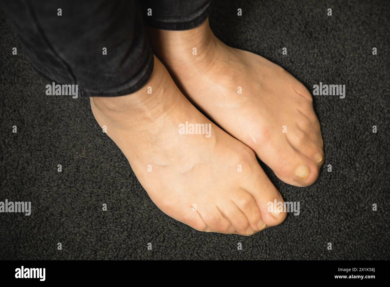 Flat feet and foot toe problems, What Problems Can Flat Feet Cause