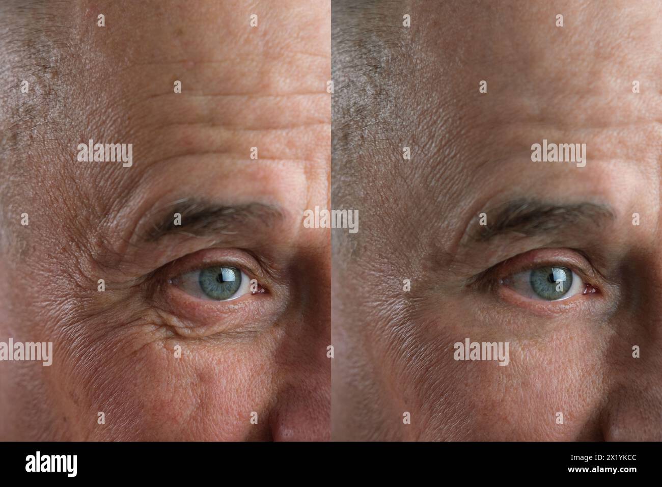 Before and after cosmetic operation. close-up of eyes and forehead of old man, senior with wrinkles on his face in two versions, wrinkles on face, ove Stock Photo