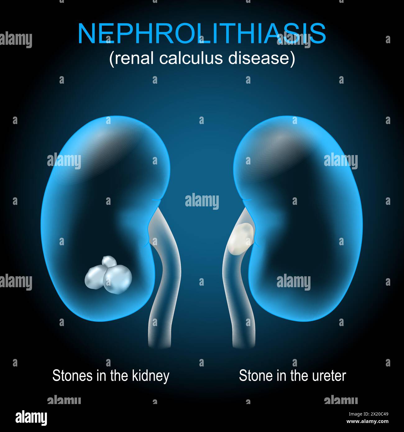 Kidney stone disease. Renal calculus disease. Nephrolithiasis or urolithiasis. Renal calculus that develops in the urinary tract. Vector illustration Stock Vector