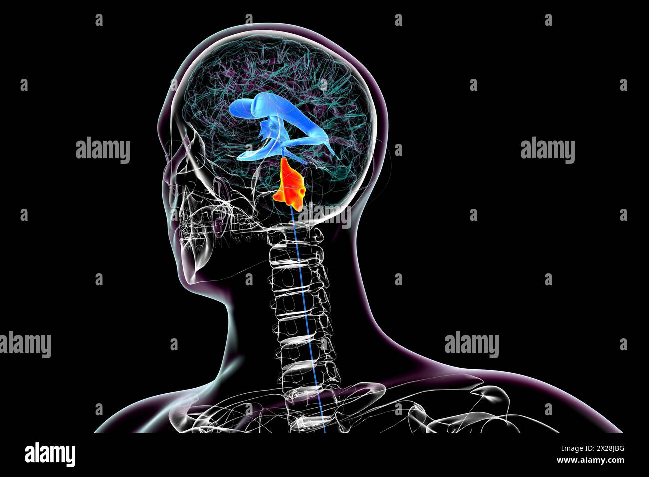 Enlargement of the fourth brain ventricle, illustration Stock Photo