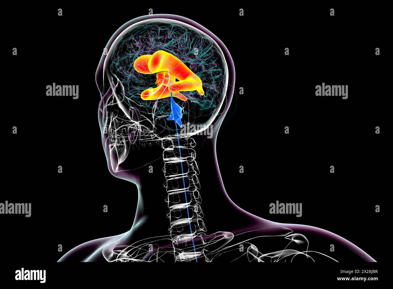 Enlarged lateral and third brain ventricles, illustration Stock Photo