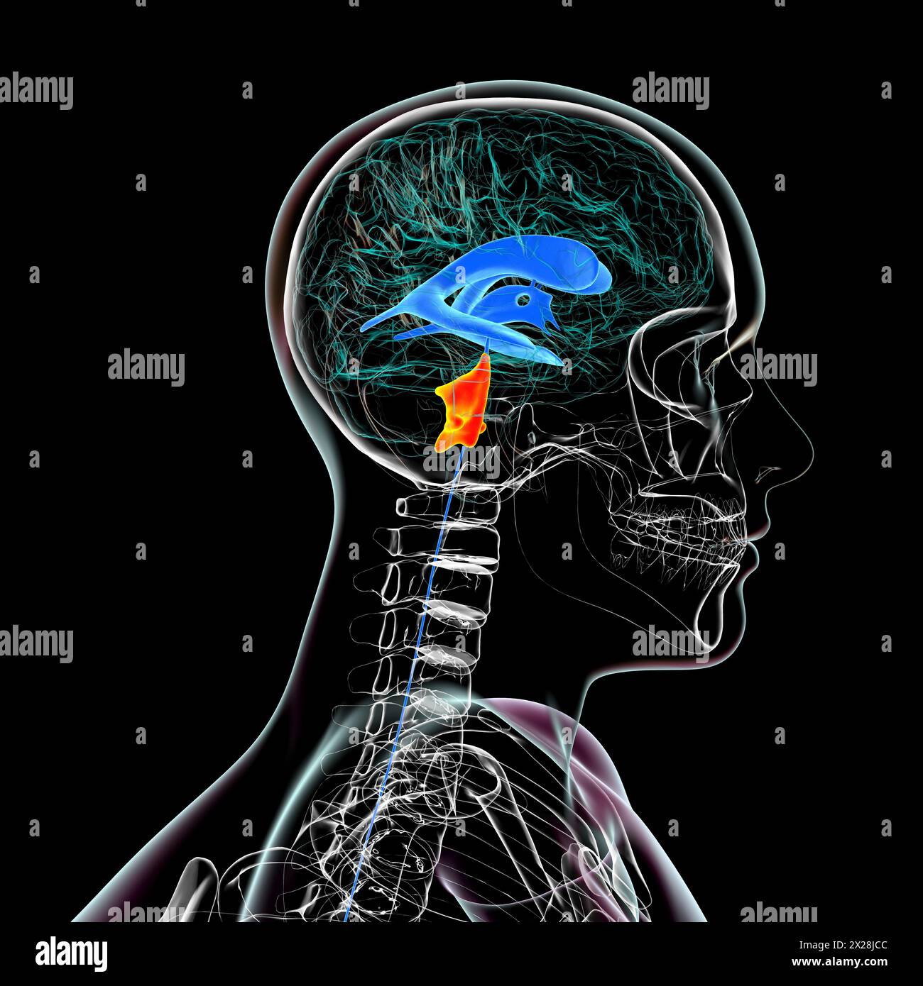 Enlargement of the fourth brain ventricle, illustration Stock Photo