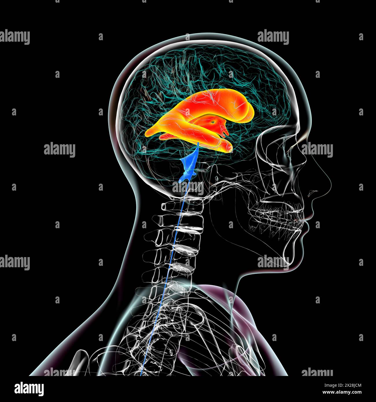 Enlarged lateral and third brain ventricles, illustration Stock Photo