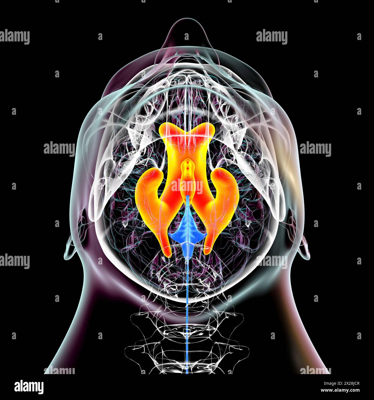 Enlarged lateral and third brain ventricles, illustration Stock Photo