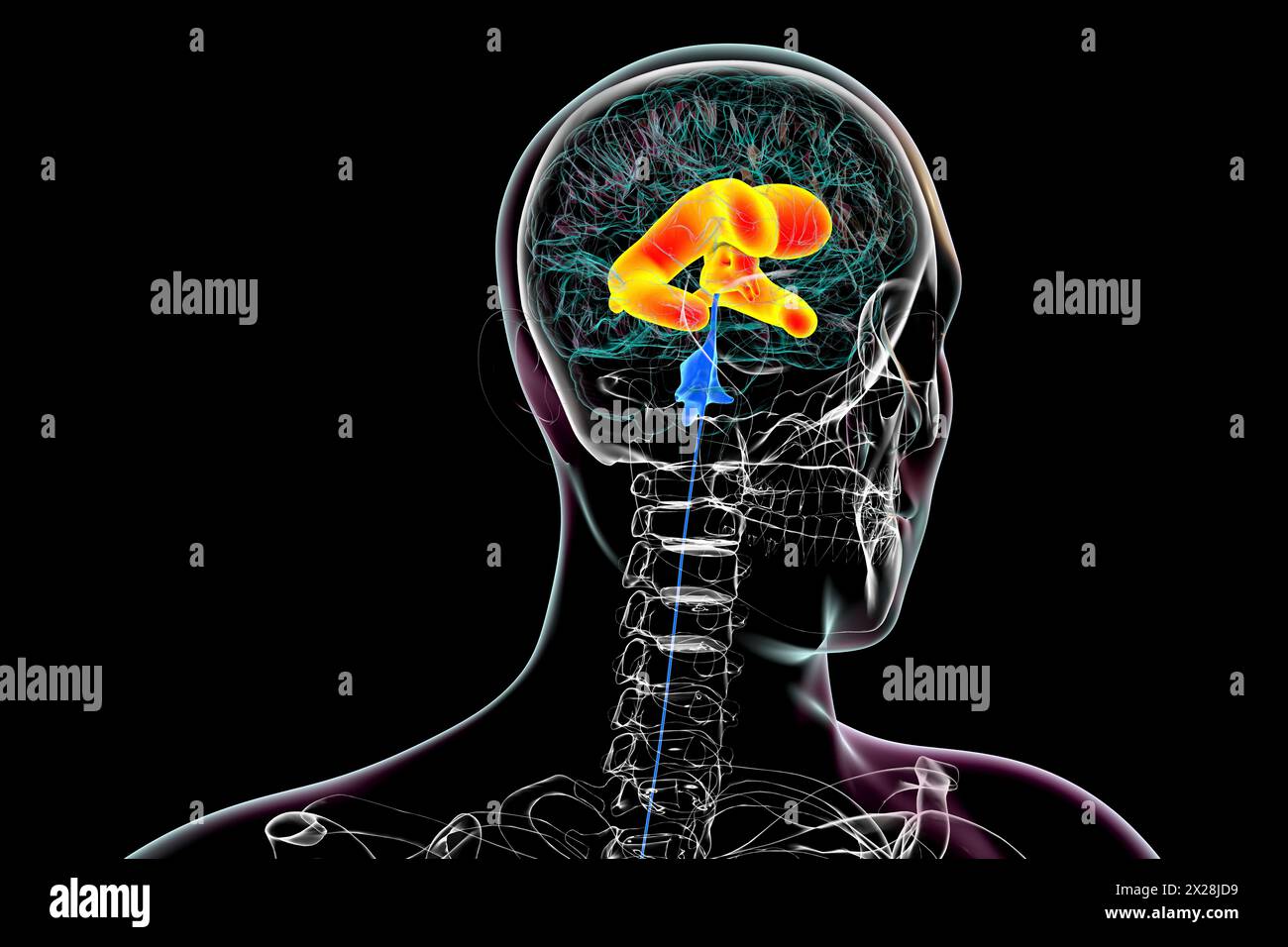 Enlarged lateral and third brain ventricles, illustration Stock Photo