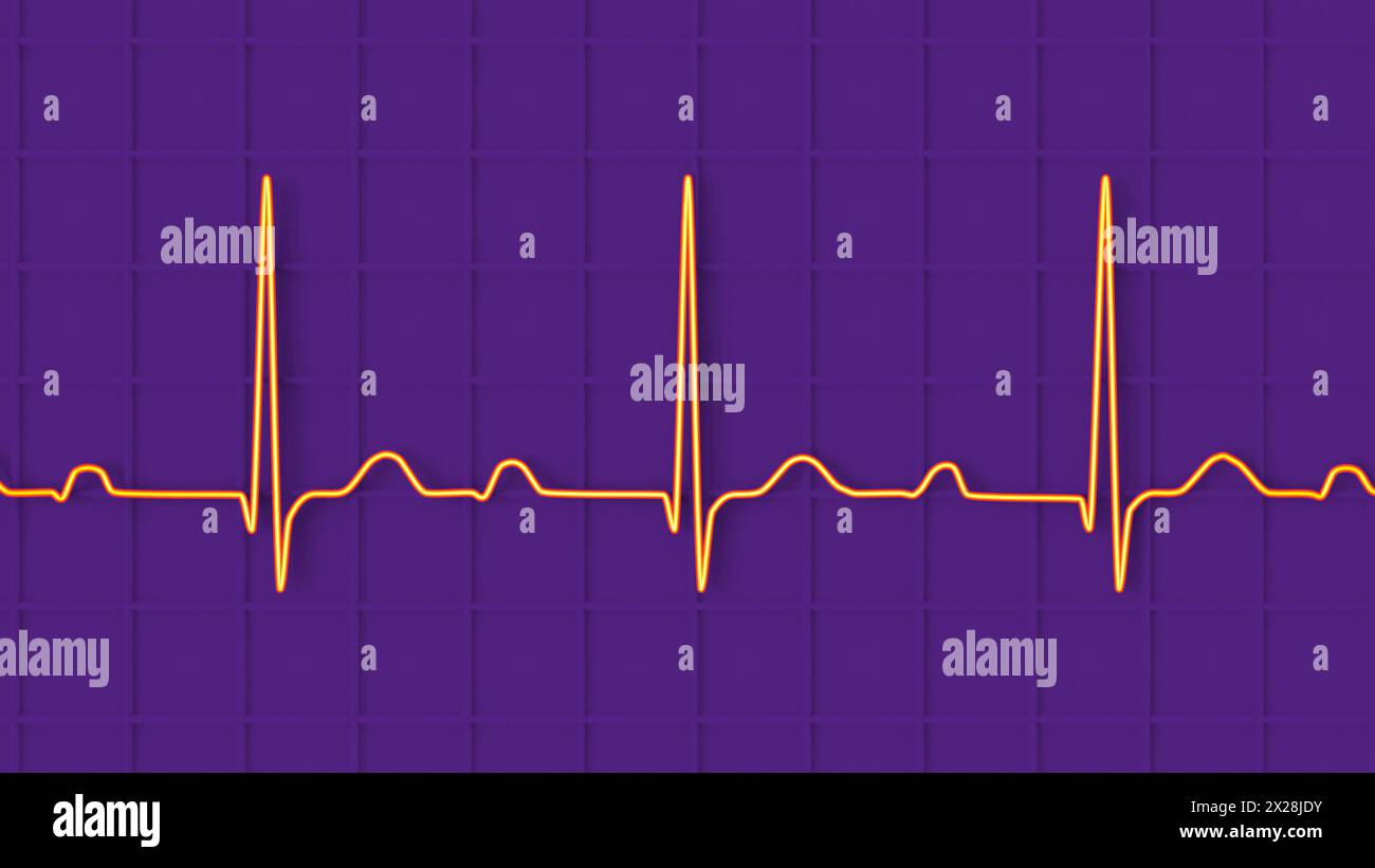 Computer illustration of an ECG (electrocardiogram) displaying first